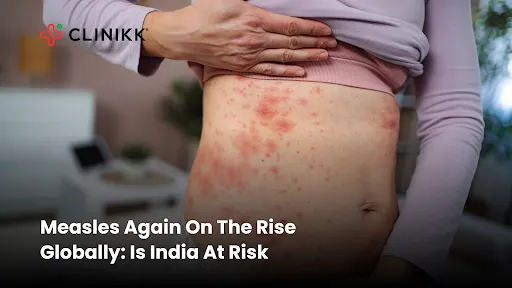 Measles Outbreak: Understanding The Global Spread And India's Risk