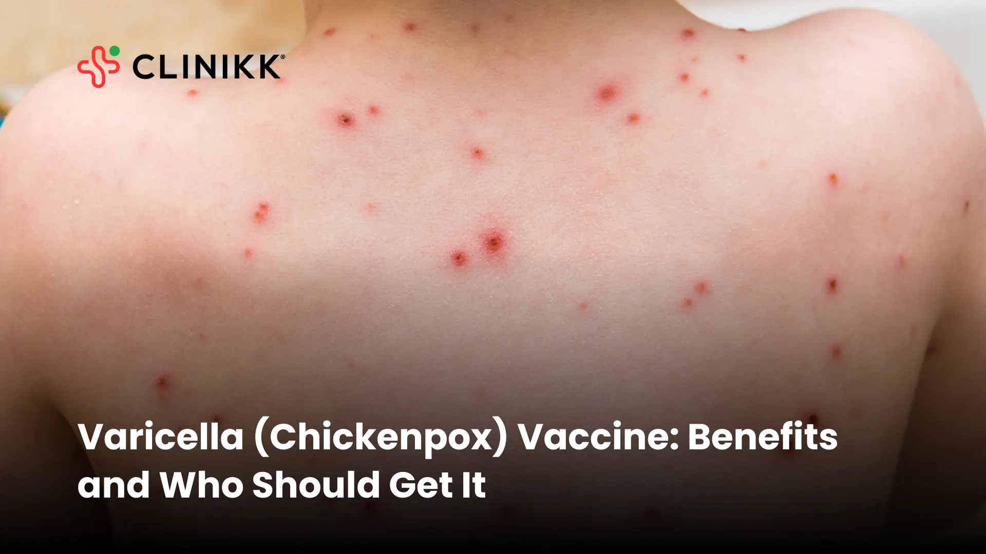 Varicella (Chickenpox) Vaccine: Benefits and Who Should Get It