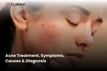 Acne Treatment