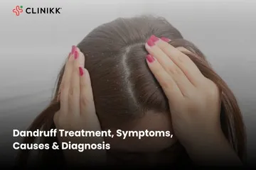 Dandruff Treatment in Bangalore
