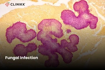 Fungal Infections