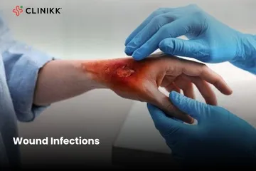 Wound Infections